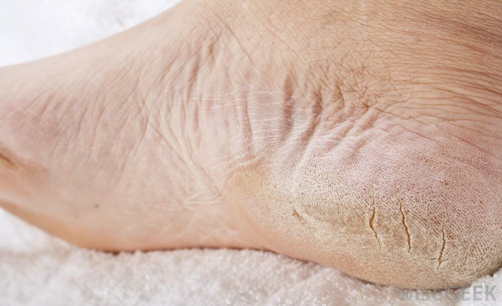 very dry feet skin